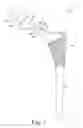 Fig. 02 - Orthopaedic surgical instrument system and method for protecting a femoral stem taper