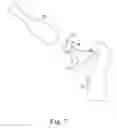 Fig. 06 - Orthopaedic surgical instrument system and method for protecting a femoral stem taper