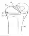 Fig. 01 - Edge-Matched Articular Implant