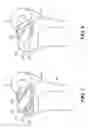 Fig. 05 - Edge-Matched Articular Implant