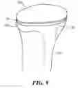 Fig. 06 - Edge-Matched Articular Implant