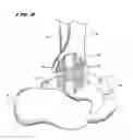 Fig. 07 - Systems and methods for installing ankle replacement prostheses