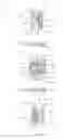 Fig. 04 - Expandable vertebral body replacement device and method