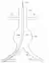 Fig. 01 - Systems and methods for guidewire crossover for bifurcated prostheses
