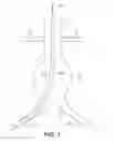 Fig. 02 - Systems and methods for guidewire crossover for bifurcated prostheses