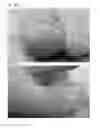 Fig. 29 - Adhesive plaster structure for treating wounds caused by ingrown nails