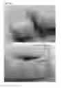 Fig. 30 - Adhesive plaster structure for treating wounds caused by ingrown nails
