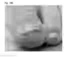 Fig. 31 - Adhesive plaster structure for treating wounds caused by ingrown nails