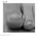 Fig. 33 - Adhesive plaster structure for treating wounds caused by ingrown nails