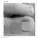 Fig. 34 - Adhesive plaster structure for treating wounds caused by ingrown nails