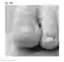 Fig. 35 - Adhesive plaster structure for treating wounds caused by ingrown nails