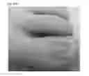 Fig. 37 - Adhesive plaster structure for treating wounds caused by ingrown nails