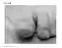 Fig. 40 - Adhesive plaster structure for treating wounds caused by ingrown nails