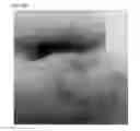 Fig. 41 - Adhesive plaster structure for treating wounds caused by ingrown nails