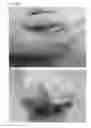 Fig. 43 - Adhesive plaster structure for treating wounds caused by ingrown nails