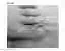 Fig. 44 - Adhesive plaster structure for treating wounds caused by ingrown nails