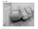 Fig. 45 - Adhesive plaster structure for treating wounds caused by ingrown nails