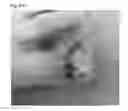 Fig. 46 - Adhesive plaster structure for treating wounds caused by ingrown nails