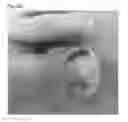 Fig. 48 - Adhesive plaster structure for treating wounds caused by ingrown nails
