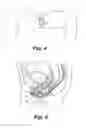 Fig. 03 - Article and method for maintaining menstrual fluid within the vagina