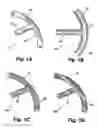 Fig. 02 - Shunt device and method for treating ocular disorders