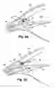 Fig. 07 - Shunt device and method for treating ocular disorders