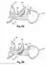 Fig. 07 - Reversible airway device and related method for ventilating a subject