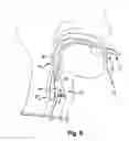 Fig. 09 - Reversible airway device and related method for ventilating a subject
