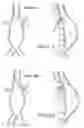 Fig. 07 - Fenestration devices, systems, and methods