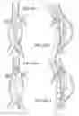 Fig. 09 - Fenestration devices, systems, and methods