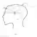 Fig. 02 - EQUIPMENT FOR APPLYING ACTIVE ELEMENTS TO THE SKULL OF A PATIENT