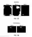 Fig. 08 - Reactive oxygen species production by myeloid-derived suppressor cells as a predictor of patient response to interferon-α therapy