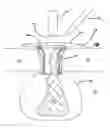 Fig. 01 - Systems and methods for tissue removal
