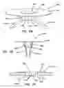 Fig. 35 - Systems and methods for tissue removal