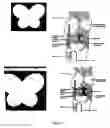 Fig. 04 - Sutureless Repair of Soft Tissue