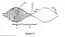 Fig. 09 - Devices for vascular occlusion