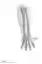 Fig. 08 - METHODS FOR INTEGRATING SENSORS AND EFFECTORS IN CUSTOM THREE-DIMENSIONAL ORTHOSIS