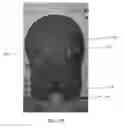 Fig. 07 - APPARATUS AND METHOD FOR COOLING HEAD INJURY