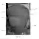 Fig. 08 - APPARATUS AND METHOD FOR COOLING HEAD INJURY