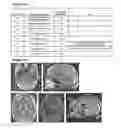 Fig. 52 - Administration of Engineered T Cells for Treatment of Cancers in the Central Nervous System