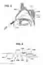Fig. 04 - Devices and methods for transnasal irrigation or suctioning of the sinuses