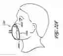 Fig. 27 - Volume-adjustable manual ventilation device