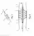 Fig. 06 - ASSEMBLY WITH A GUIDE WIRE AND A FIXATOR FOR ATTACHING TO A BLOOD VESSEL