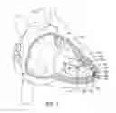 Fig. 02 - Delivery system with force sensor for leadless cardiac device
