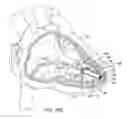 Fig. 13 - Delivery system with force sensor for leadless cardiac device