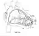 Fig. 15 - Delivery system with force sensor for leadless cardiac device