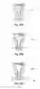 Fig. 32 - Lean-burn pre-combustion chamber