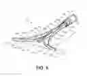 Fig. 06 - Methods and systems for endometrial ablation utilizing radio frequency
