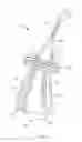 Fig. 02 - Graft suspension device