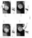 Fig. 07 - Feedback for providing artificial bone flap